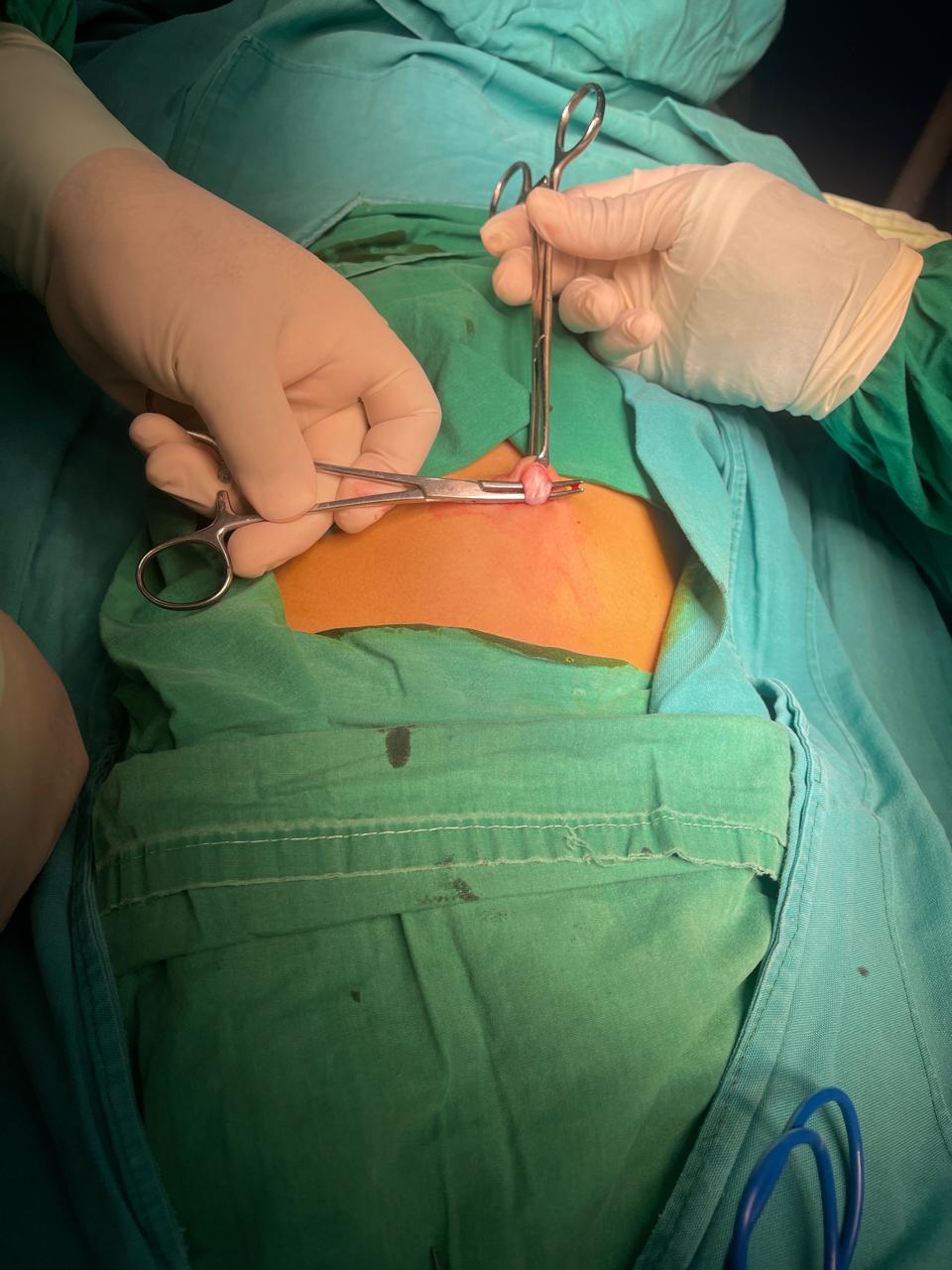 Realizando hernioplastia ,hernia umbilical .