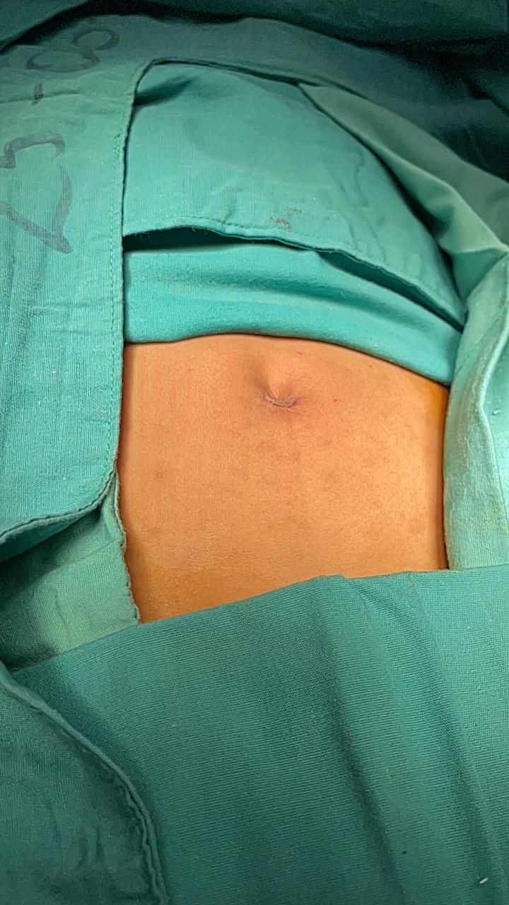 Caso de hernia umbilical ya corregida.